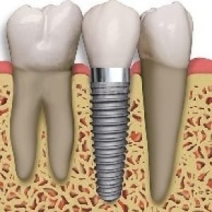 Painless-Implants-dental-clinic-in-malviya-nagar