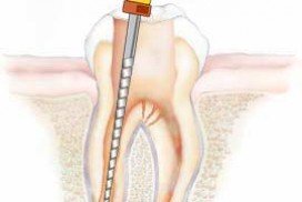 Root-canal-treatment at Geetanjali dental options