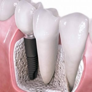 Tooth Implants cost in India
