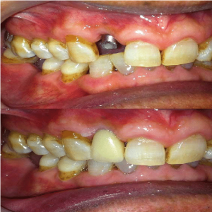 Tooth Implantation 