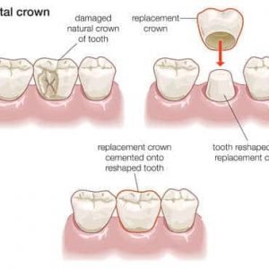 crown prepration by best dentist in delhi