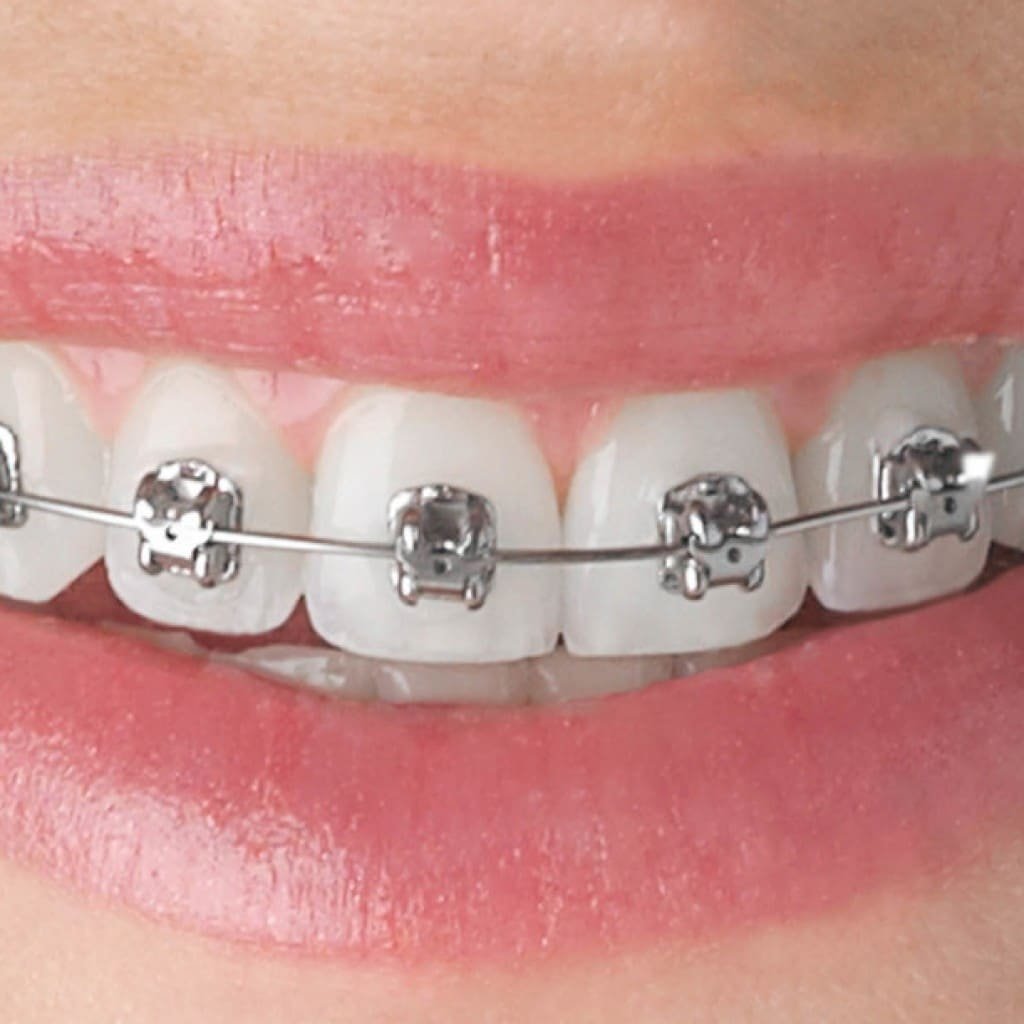 Best Orthodontist in South DelhiBRACES WITHOUT EXTRACTION