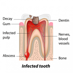 Painless-root-canal-treatment-in-delhi