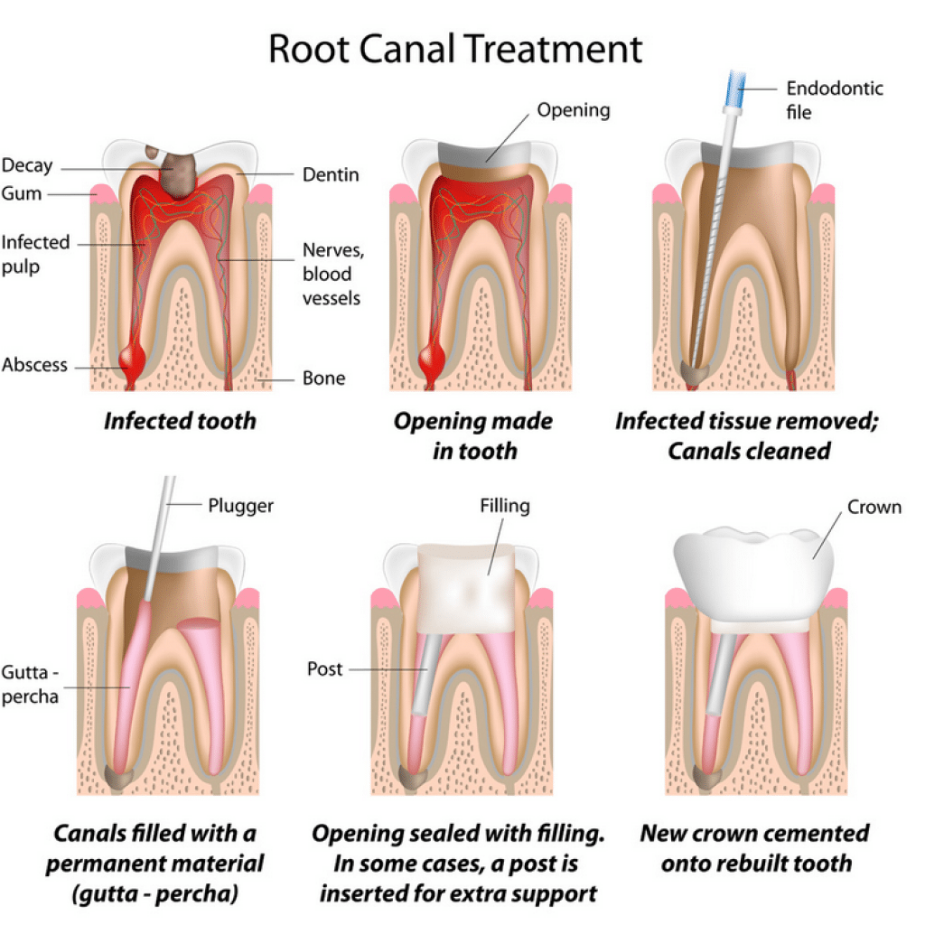 rct-1-geetanjali-dental-options