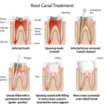 rct 1 | Geetanjali Dental Options