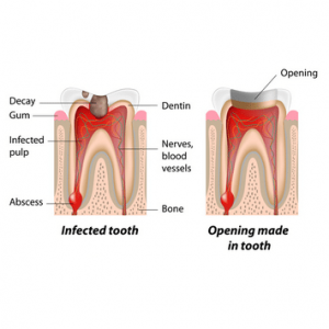 Best-root-canal-Specialist-in-delhi