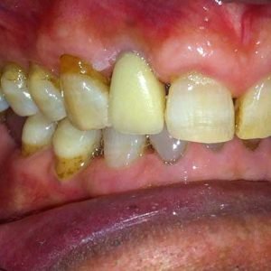 dental implants in delhi a
