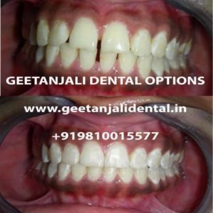 best orthodontist in delhi:Invisible braces in Delhi ,Invisalign in Delhi