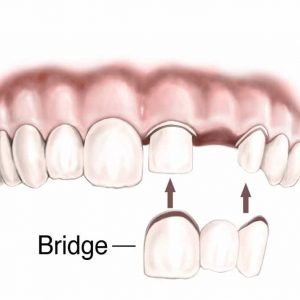 Replace Missing teeth :Now Permanent and easy with Bridge or Implants