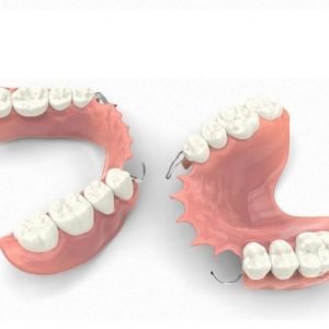 Removable Dentures are the cheapest means of replacing teeth.