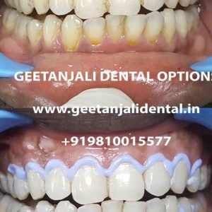 laser teeth whitening in delhi