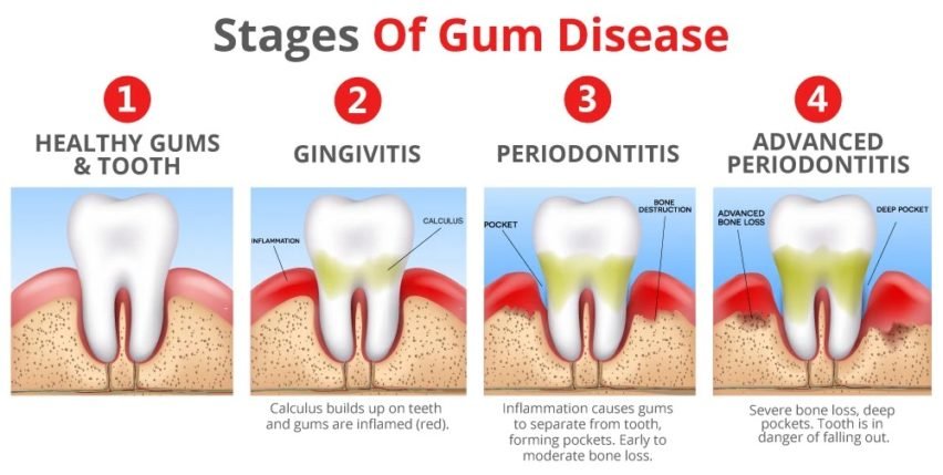 stages of gum disease Geetanjali Dental Options:Gum Bleeding Treatment in South Delhi ,Gum Disease Treatment in South Delhi,Periodontal Treatment in South Delhi ,Bad Breath Treatment in South Delhi,Pyrohea