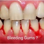 gum-bleeding-treatment-in-delhi