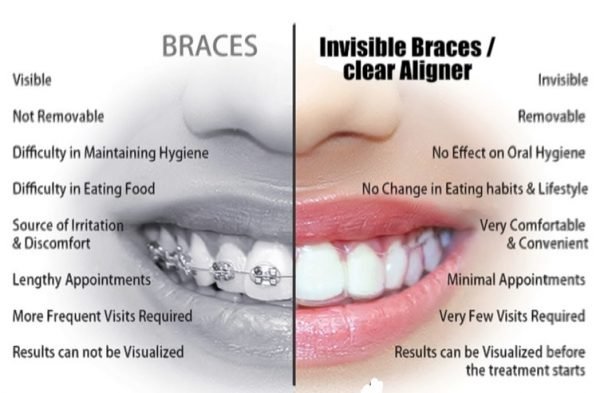 invisalign aligners teeth aligner kerajaan nha mắc không cài chỉnh