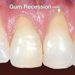 bleeding-and-swollen-gums-treatment