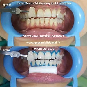 teeth-whitening-cost-delhi