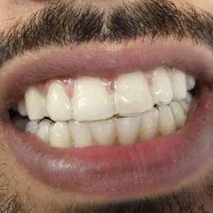 Sample how it looks after putting aligner:Invisible Braces