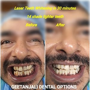 Professional teeth whitening in delhi india