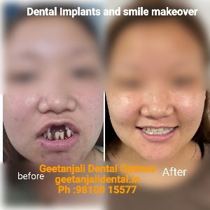Dental Clinic Delhi Best Dentist in Delhi, For Painless RCT, Dental  Implant, Single tooth Implant, Braces treatment, Invisible braces cost in  Delhi