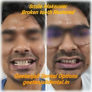 smile makeover by Dr Puneet Arora