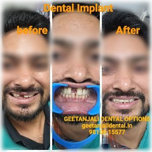 dental implant in india,best dental implantologist in dlehi