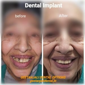 dental implant cost in india delhi,painless dental implants,best implantologist in south delhi